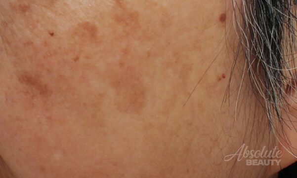 PicoＷay聚焦探頭｜痘疤處理、皮膚凹疤 1