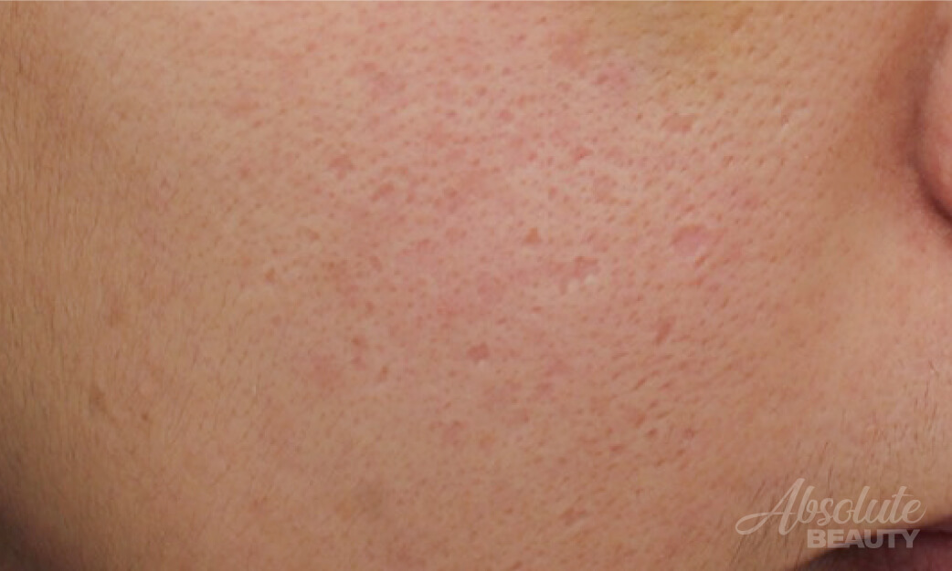 UP雷射(UltraPulse)，真皮層治療疤痕雷射，價格透明 | 膚適美診所