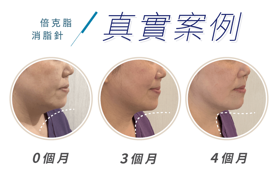倍克脂 消脂針 膚適美診所