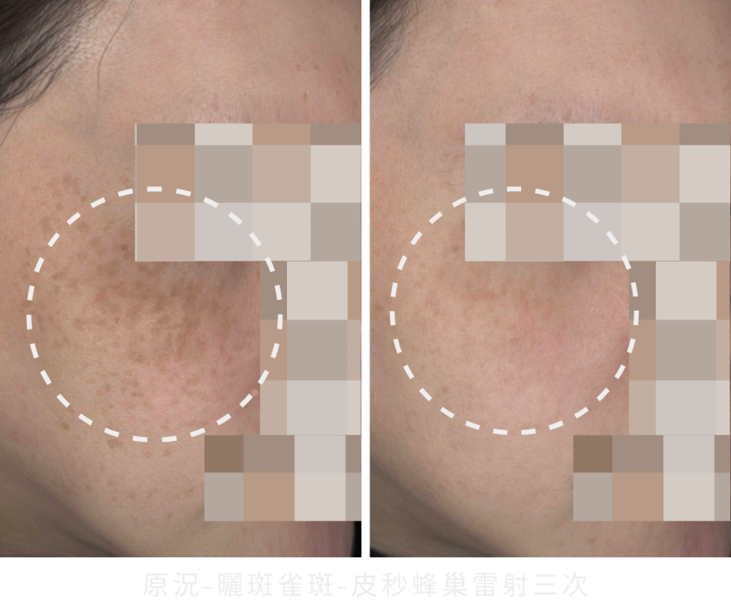 皮秒效果、皮秒雷射是什麼?皮秒雷射多久打一次?皮秒有什麼缺點?2025年最新 – 膚適美診所