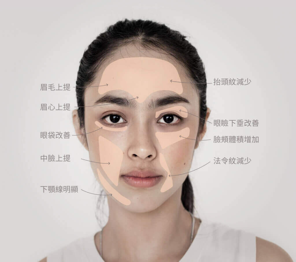 emface菲斯波治療四大區域