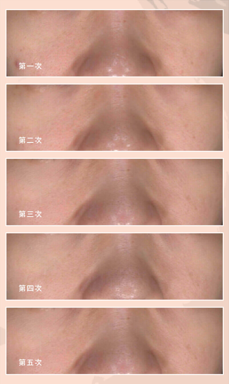 症狀案例_膚色不均2 _3