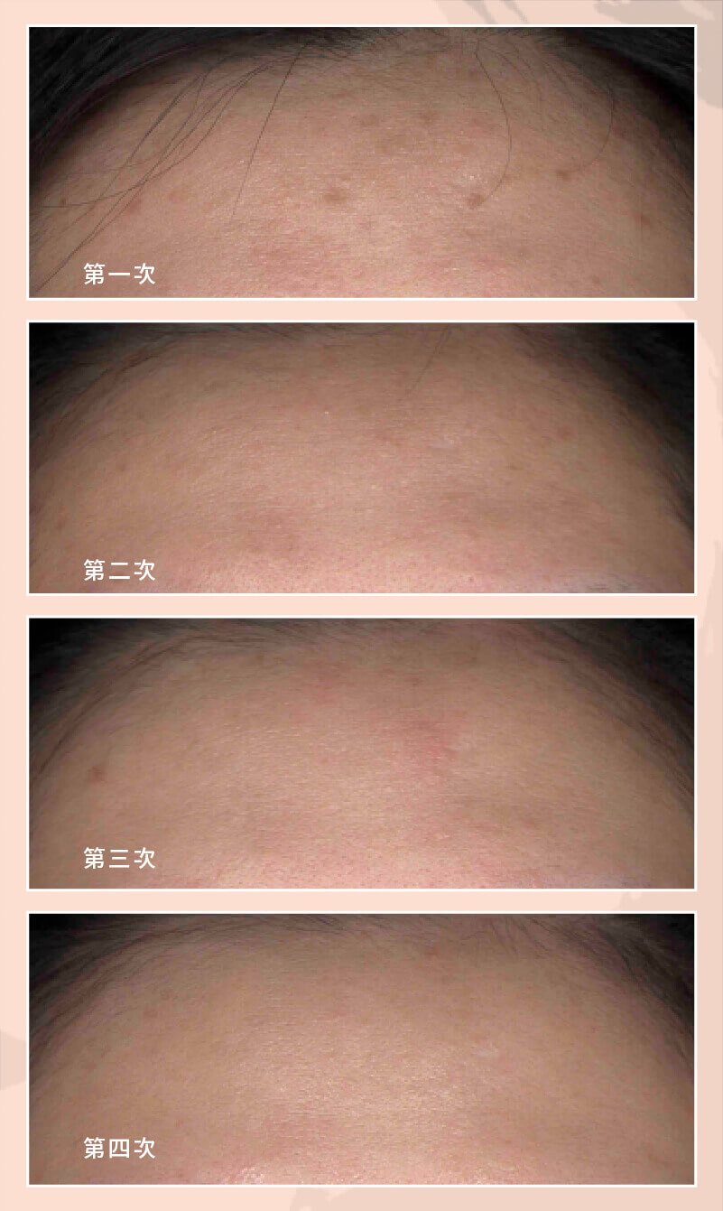 症狀案例_色素痘疤2 _3