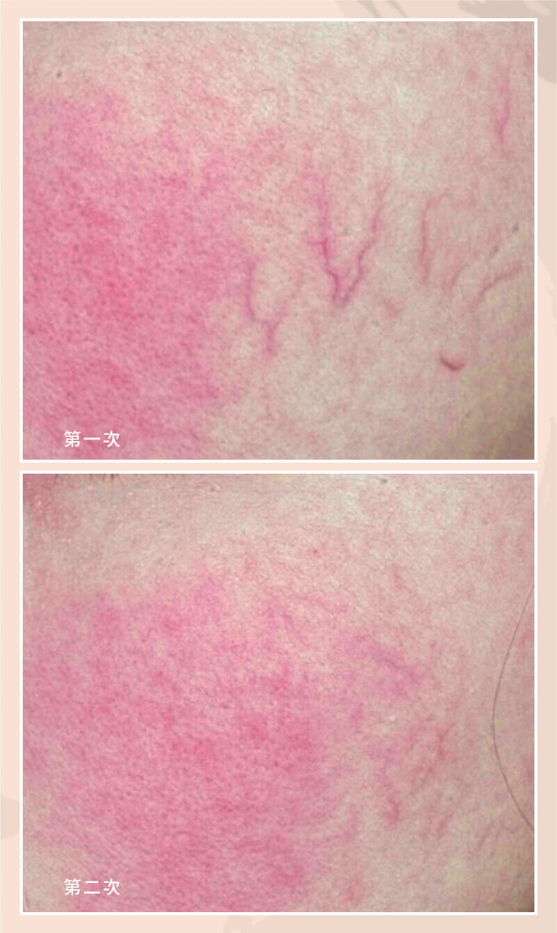 症狀案例_血管絲3