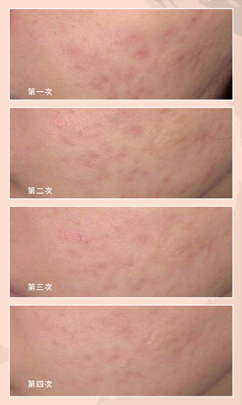 色素痘疤2
