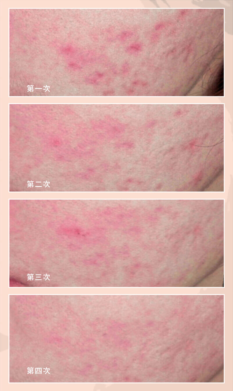 色素痘疤3