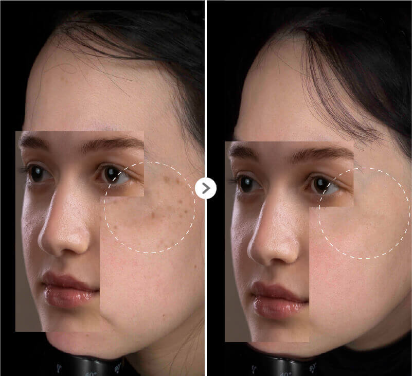 曬斑雀斑1
